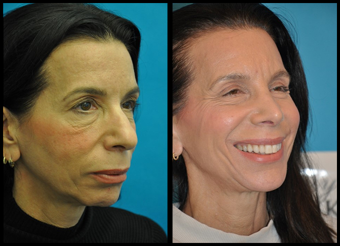 Before and After