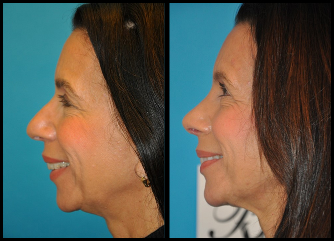 Before and After
