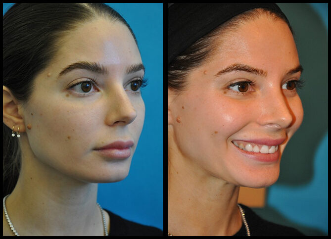 Before and After