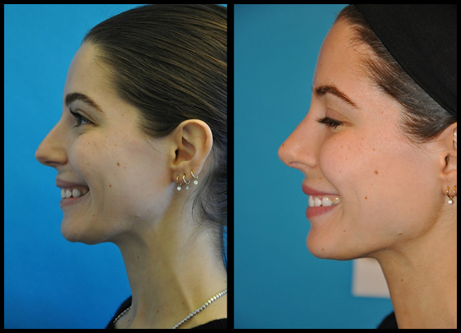 Before and After