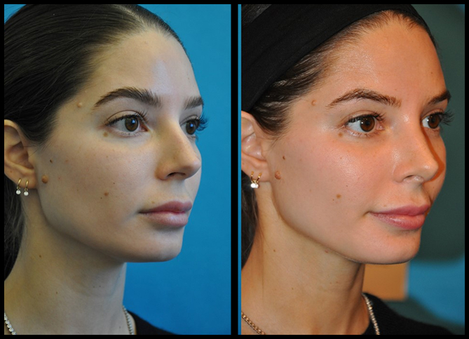 Before and After